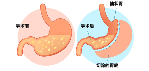 对肥胖大声说NO!——我院开展腹腔镜（微创）下胃部分切除术