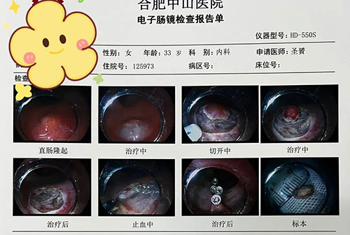 治疗消化道早期肿瘤的“利器”——内镜下粘膜剥离术（ESD）