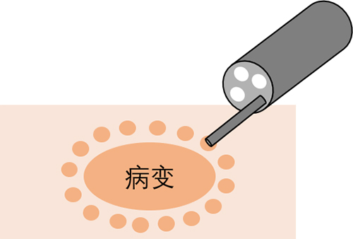 治疗消化道早期肿瘤的“利器”——内镜下粘膜剥离术（ESD）