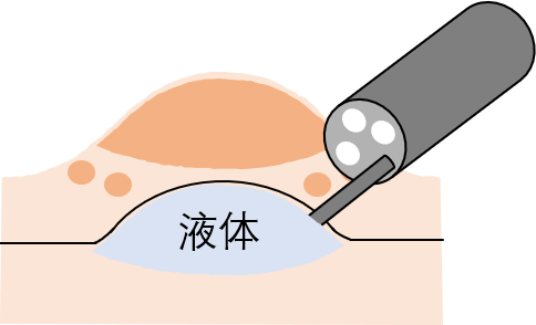 治疗消化道早期肿瘤的“利器”——内镜下粘膜剥离术（ESD）