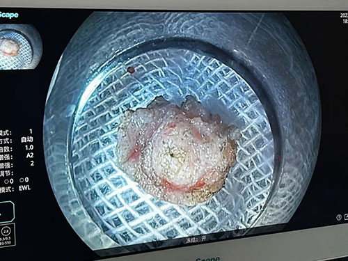 治疗消化道早期肿瘤的“利器”——内镜下粘膜剥离术（ESD）
