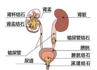 夏天来了，泌尿系结石又搞“偷袭”？