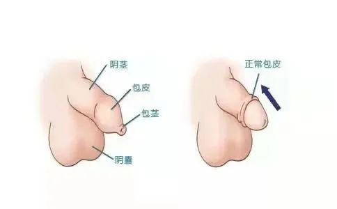 暑假割包皮，家长们关心的问题在这里