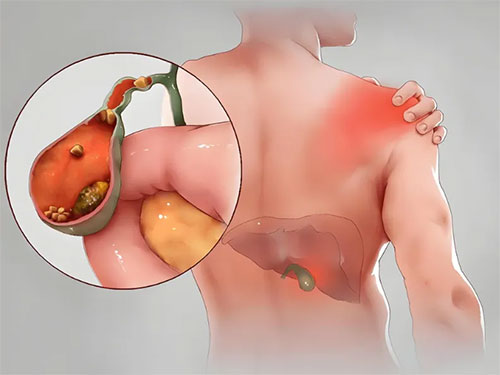 【惠民科普】胆囊里的‘不速之客’——胆囊结石