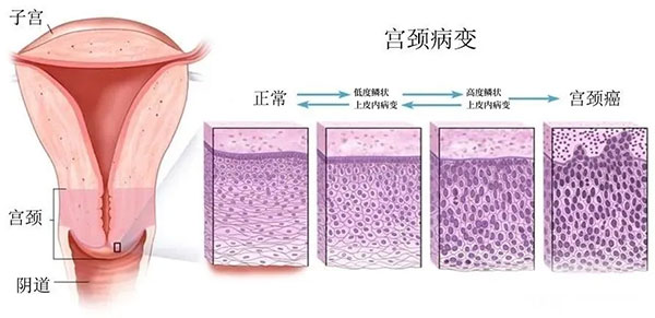 女性必看！守护“生命之花”——宫颈病变的早期识别与应对