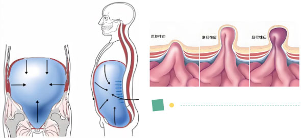 【惠民科普】健康守护，从“腹”开始——腹股沟疝