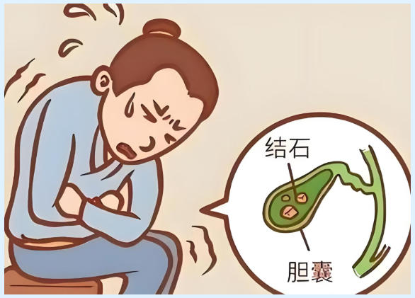 合肥中山医院经脐保胆取石：留下“房子”赶走“坏租客”