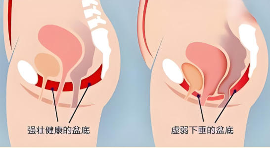 合肥中山医院科普：你的盆底肌，可能正在“过劳”或“躺平”
